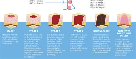 Skin Ulcer Stages