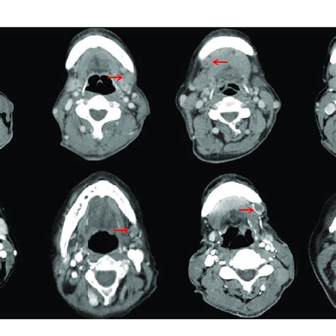 Independent Predictive Factors Associated With Level Ib Lymph Node