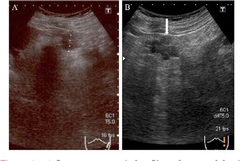 Figure 1 From Rare Case Of Pancreatic Cystic Lymphangioma Semantic