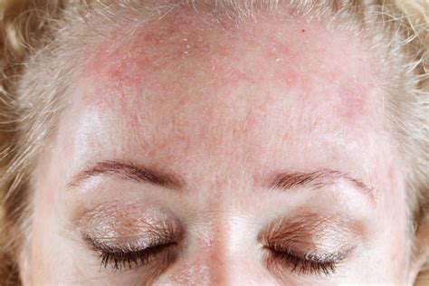 Dermatitis Seborreica Mujer Bonica