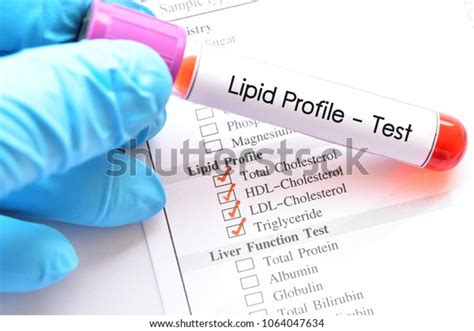 Blood Sample Lipid Profile Test Stock Photo 1064047634 Shutterstock