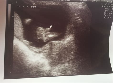 Ultrasound At 16 Weeks Gender | Images and Photos finder