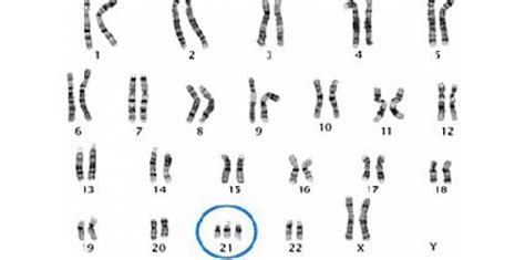 Trisomie 21 Désactiver Le Chromosome En Trop 19 Juillet 2013