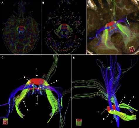 High Resolution Diffusion Tensor Imaging And Tractography In Joubert