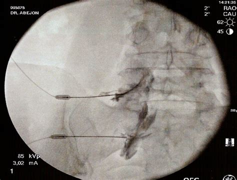 Denervação Percutânea De Faceta Articular Por Segmento Cultura Notícias