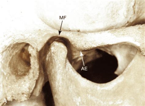 TMJ Anatomy And Definitions Flashcards Quizlet