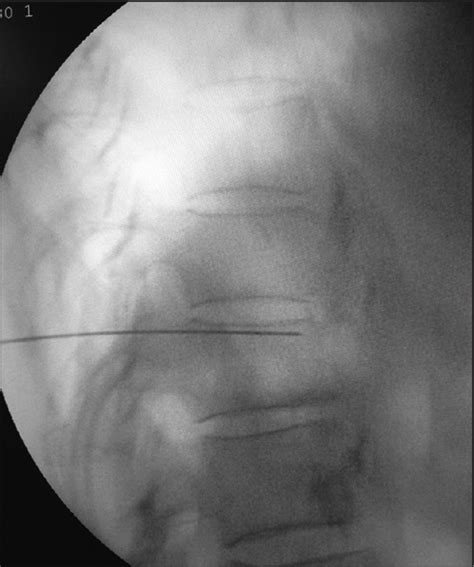 Fluoroscopy Guided Neurolytic Splanchnic Nerve Block For Intractable