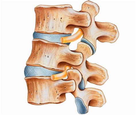 Hyperlordosis: Treatment, exercises, and diagnosis