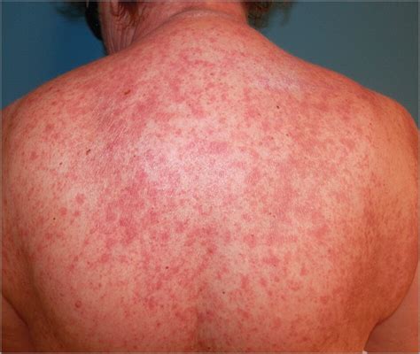 Subacute Cutaneous Lupus