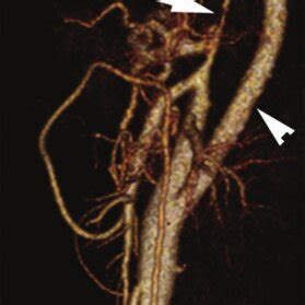 Volume Rendered Image From A Computed Tomography Angiogram Of The Chest