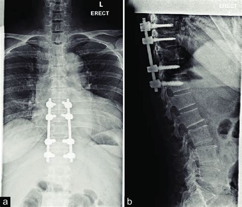 T To T Instrumentation And Fixation T Laminectomy And Excision Of