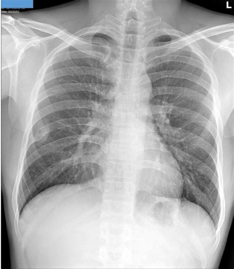 Vietnamese Medic Ultrasound Case 682 Rib Chondrosarcoma Dr Phan