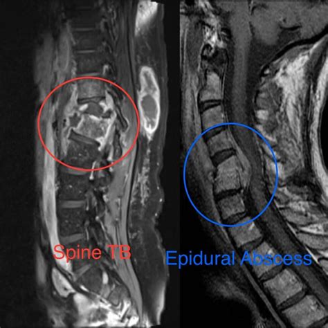 Spinal Infections Dr Bharat Shinde