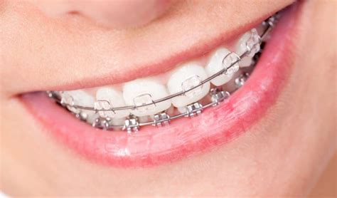 How To Get Rid Of Gingivitis With Braces