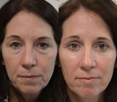 Eyelid Surgeon Blepharoplasty Eyelid Lift And Surgery Nj