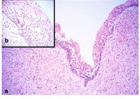 Calcifying Epithelial Odontogenic Tumor Histology