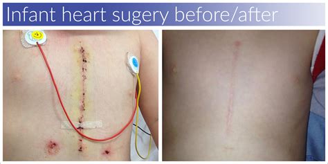 Open Heart Surgery And Scar Care