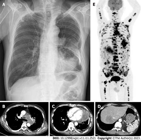 Smarca4 Deficient Undifferentiated Thoracic Tumor A Case Report