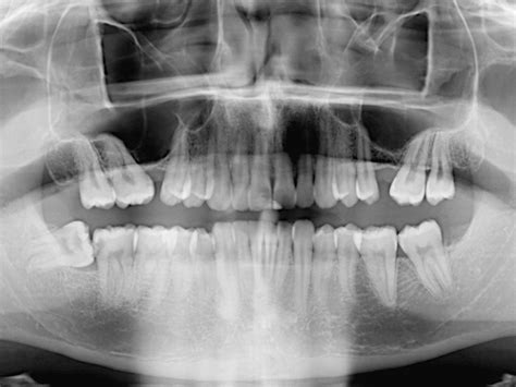 The coronectomy technique : Scottish Dental magazine