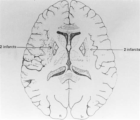 Lentiform Nucleus Mri