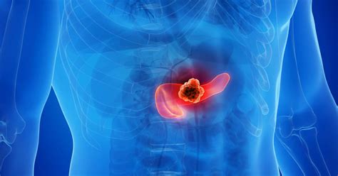 Cáncer De Páncreas Gnc Farmácia