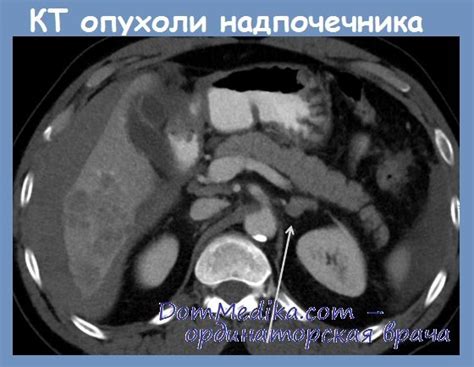 Как выглядит раковая опухоль во рту фото
