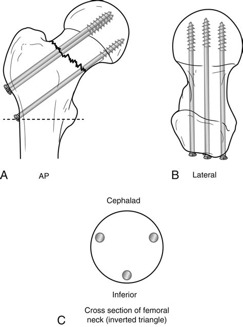 Open Reduction And Internal Fixation Of Femoral Neck Fractures