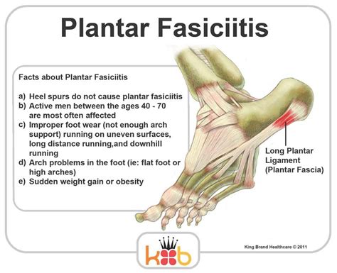 Pin on Plantar Fasciitis