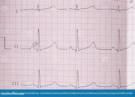 Gr Fico Ekg Do Eletrocardiograma Card Aco Em Papel Especial Conceito