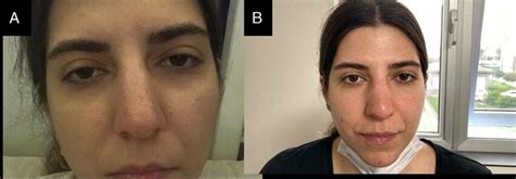 A Bilateral Ptosis At Presentation B Improvement Of Ptosis At Sixth Download Scientific