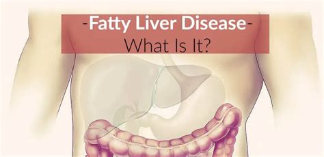 What Is Fatty Liver Disease Signs And Symptoms