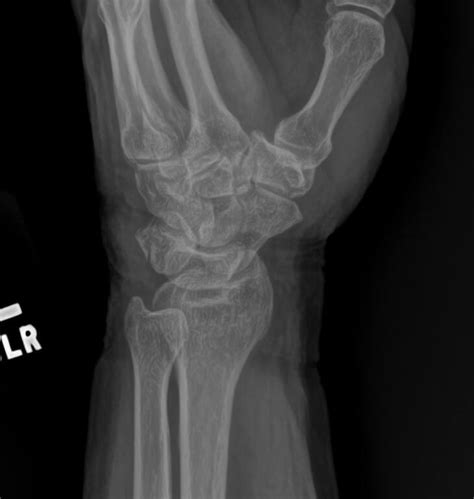 Orthodx Triquetral Fracture Of Left Wrist Clinical Advisor