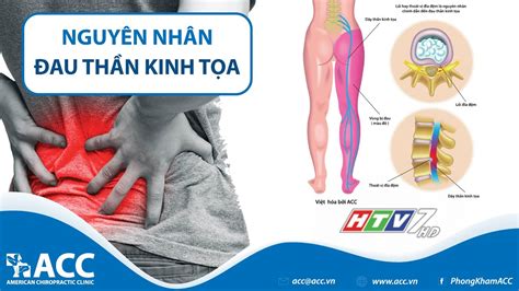 Khám phá hình ảnh đau dây thần kinh tọa giúp bạn hiểu rõ hơn