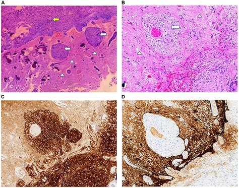 Frontiers Case Report Meningioma Associated With