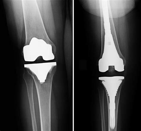 Revision Total Knee Replacement Orthoinfo Total Knee Replacement