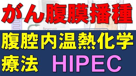 がんの腹膜播種に対する腹腔内温熱化学療法 Hipec：卵巣癌での研究結果 がん情報チャンネル