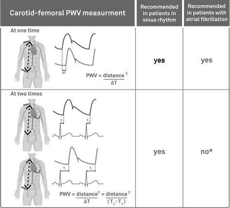 Arterial Stiffness And Atrial Fibrillation Shared Mechanism