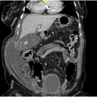 Coronal Section Of Abdominal Ct With Iv Contrast Showed Distended