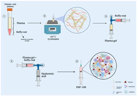 Bioengineering Free Full Text Platelet Rich Plasma Gel Matrix Prp