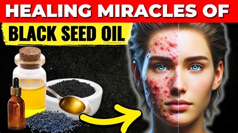 10 Black Seed Oil Benefits 95 Of People Dont Know These Health Benefits Of Black Seed Oil