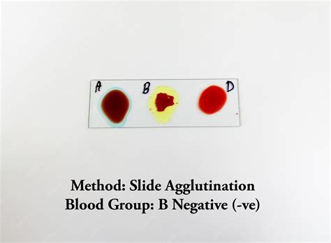 premium photo blood grouping   agglutination method show
