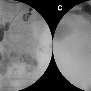 Eus Guided Antegrade Stenting A Duodenal Narrowing In A Patient With