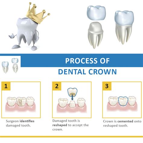 A Crown Is A Cover Or Cap” We Can Put Over A Tooth The Crown