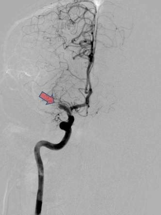 Right Mca Infarction With Thrombectomy Radiology Case Radiopaedia Org