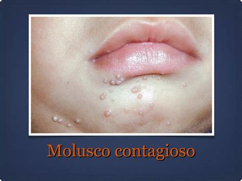 Molusco Contagioso PPT