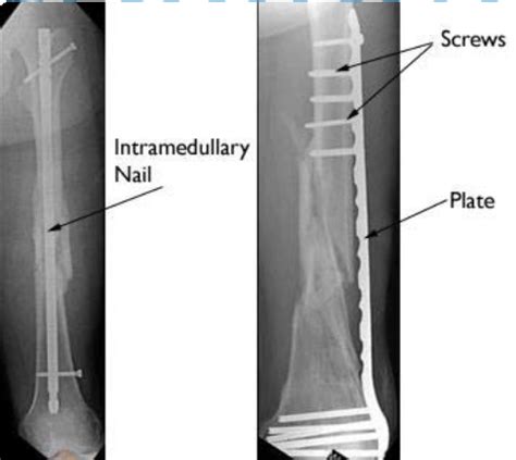 Internal Fixation Fractures Boston Medical Center