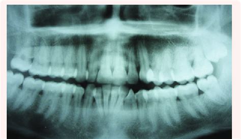 Opg Showing Normal Bone Pattern Download Scientific Diagram