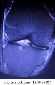 Magnetic Resonance Imaging Mri Knee Posterior Stock Photo 1274427307