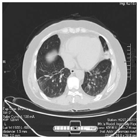 High Resolution Computed Tomography Scan Showing Multiple Nodular