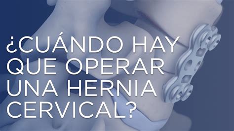 Cuándo hay que operar una hernia cervical YouTube